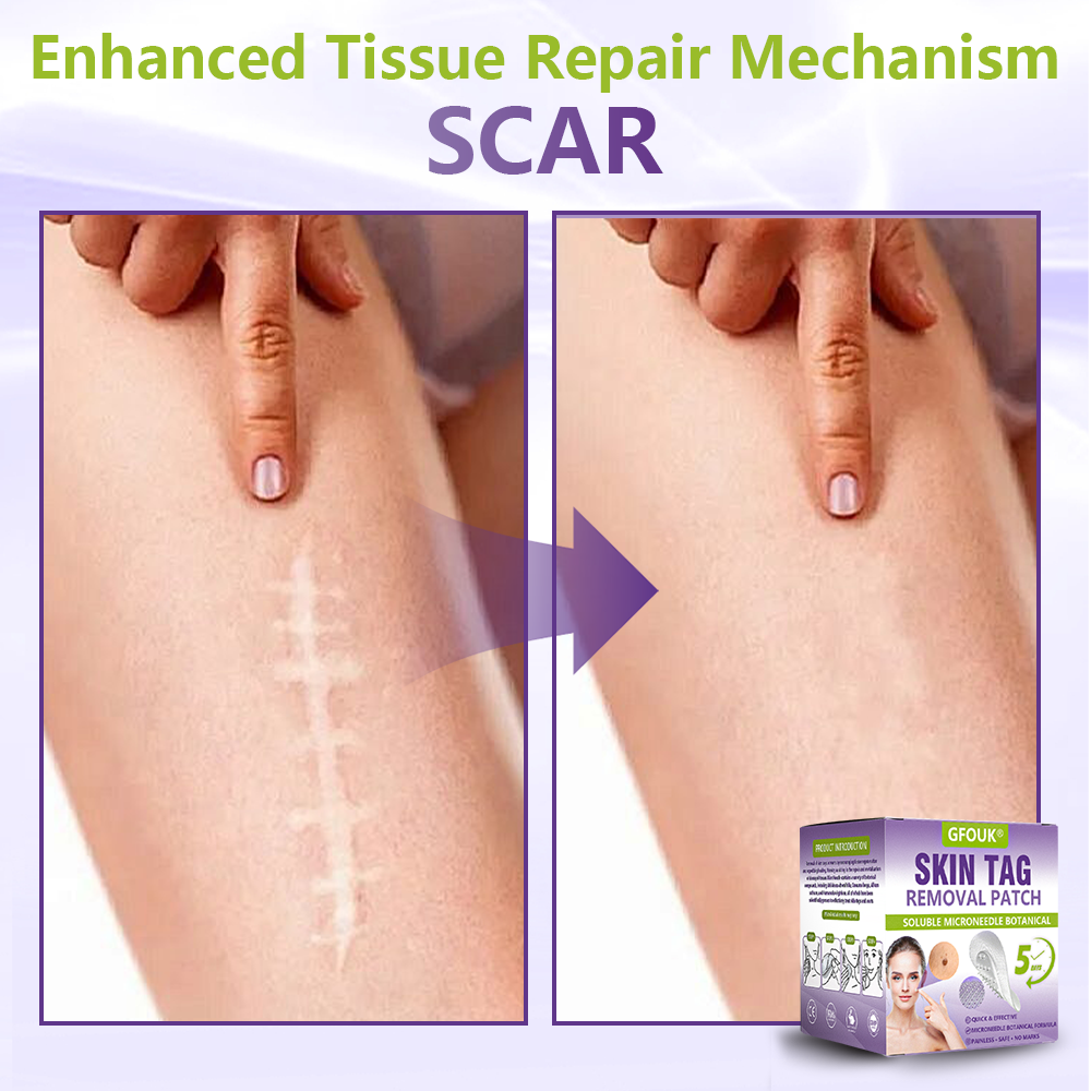 Made and Shipped from USA ✨GFOUK® Soluble Microneedle Botanical Skin Tag Removal Patch🍇