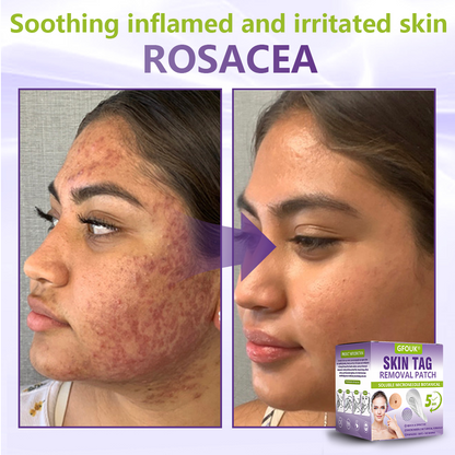 Made and Shipped from USA ✨GFOUK® Soluble Microneedle Botanical Skin Tag Removal Patch🍇