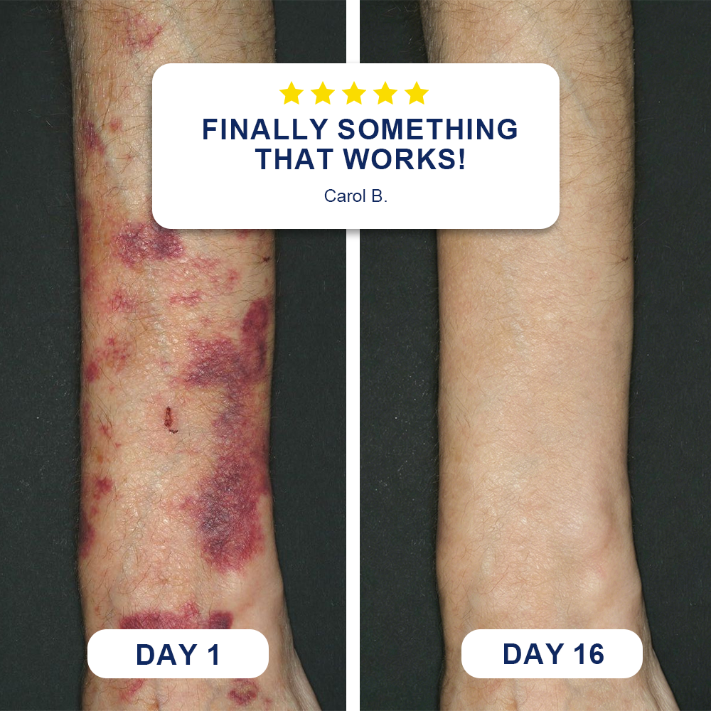 ✨ Bruise-Prone Skin? Discover Evolvion® Bruise Repair & Skin-Strengthening Cream🍀