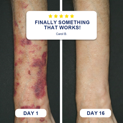 ✨ Bruise-Prone Skin? Discover Evolvion® Bruise Repair & Skin-Strengthening Cream🍀