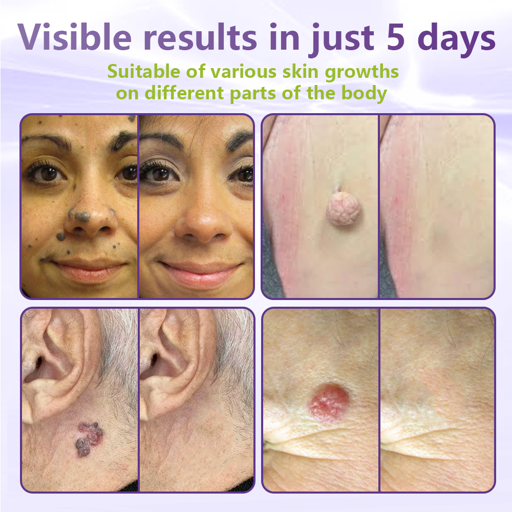 Made and Shipped from USA ✨GFOUK® Soluble Microneedle Botanical Skin Tag Removal Patch🍇