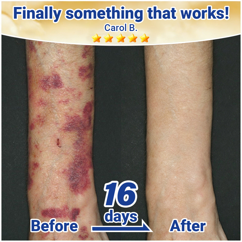 Evolvion® Senile Purpura, Bruise & Fragile Skin Repair Cream💛
