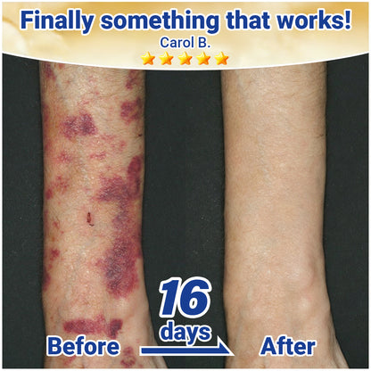 Evolvion® Senile Purpura, Bruise & Fragile Skin Repair Cream💛