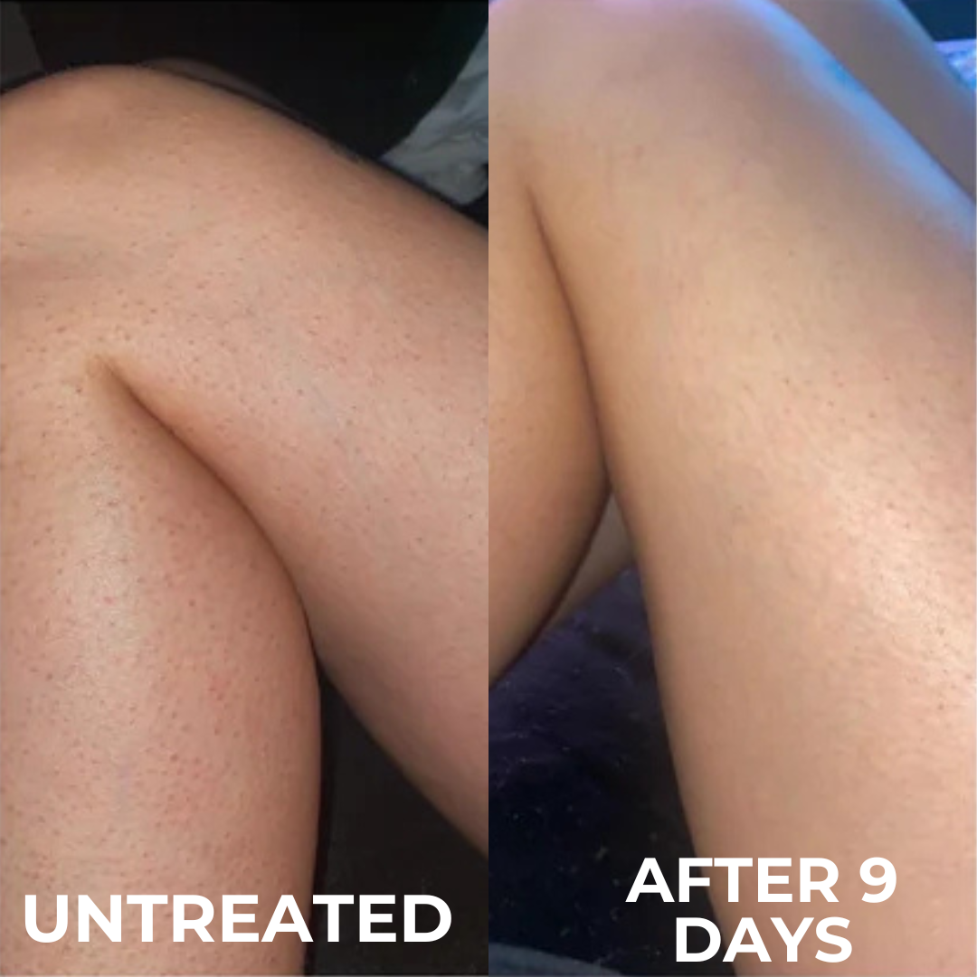Advanced Triple-Acid Complex for Keratosis Pilaris