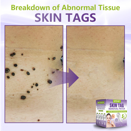 Made and Shipped from USA ✨GFOUK® Soluble Microneedle Botanical Skin Tag Removal Patch🍇
