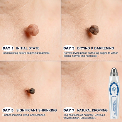 Made and Shipped from USA ✨Evolvion® 𝟕-𝐃𝒂𝘆 𝐒𝗸𝐢𝐧 𝐓𝒂𝗴 & 𝐒𝐩𝙤𝐭 𝐄𝐫𝒂𝐬𝙚𝐫 Painless & Scar-Free Advanced Imperfection Remova𝗜 Ro𝗜𝗜erba𝗜𝗜 Pen 🌼