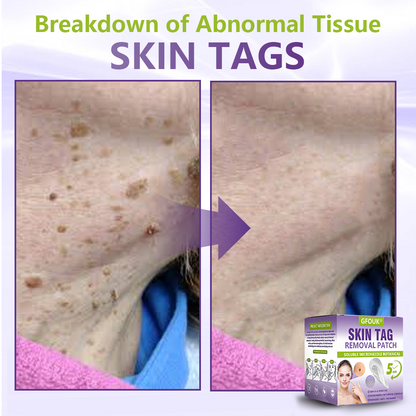 Made and Shipped from USA ✨GFOUK® Soluble Microneedle Botanical Skin Tag Removal Patch🍇
