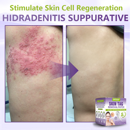 Made and Shipped from USA ✨GFOUK® Soluble Microneedle Botanical Skin Tag Removal Patch🍇