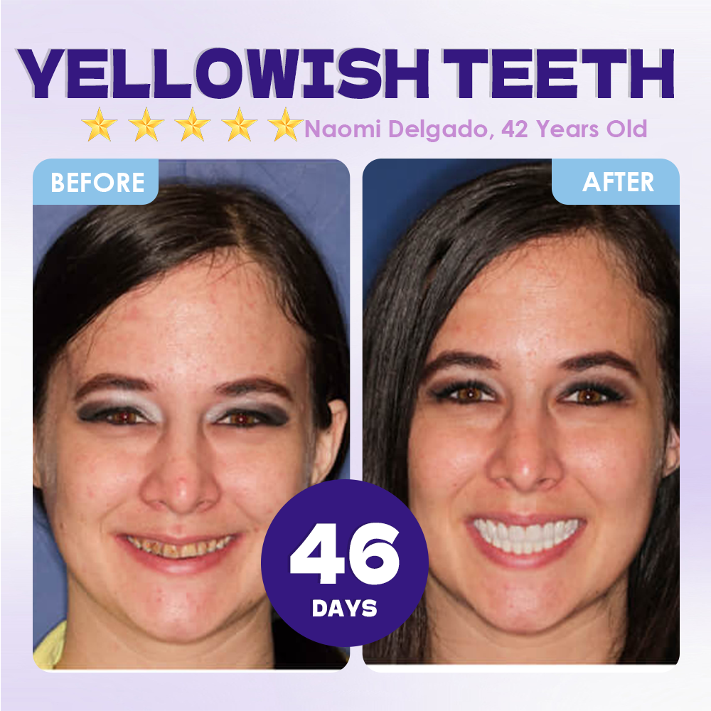 GFOUK® Tideglusib Tooth & Gum Repair Oral Microneedle Patch  | 𝐀𝐝𝐯𝐚𝐧𝐜𝐞𝐝 𝐒𝐭𝐞𝐦-𝐂𝐞𝐥𝐥 𝐀𝐜𝐭𝐢𝐯𝐚𝐭𝐢𝐨𝐧 𝐓𝐞𝐞𝐭𝐡 𝐒𝐭𝐫𝐢𝐩𝐬(🦷𝐑𝐞𝐛𝐮𝐢𝐥𝐝 𝐄𝐧𝐚𝐦𝐞𝐥 & 𝐃𝐞𝐧𝐭𝐢𝐧 • 𝐒𝐭𝐫𝐞𝐧𝐠𝐭𝐡𝐞𝐧 𝐆𝐮𝐦𝐬 • 𝐄𝐫𝐚𝐝𝐢𝐜𝐚𝐭𝐞 𝐓𝐚𝐫𝐭𝐚𝐫 & 𝐎𝐝𝐨𝐫 • 𝐒𝐭𝐨𝐩 𝐓𝐨𝐨𝐭𝐡 𝐒𝐞𝐧𝐬𝐢𝐭𝐢𝐯𝐢𝐭𝐲)